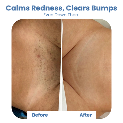 Smuth™ Ingrown Rescue