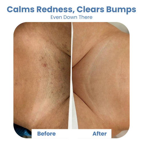 Smuth™ Ingrown Rescue