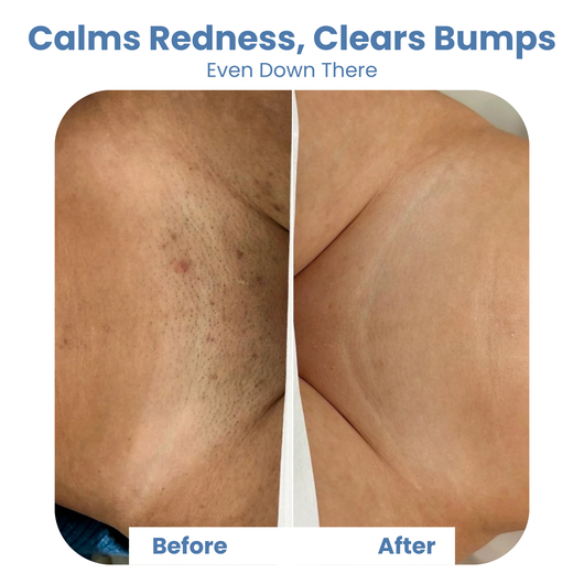 Smuth™ Ingrown Rescue